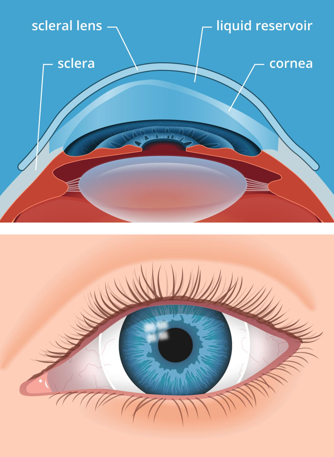 Contacts Wichita Ks Opticology Eyecare